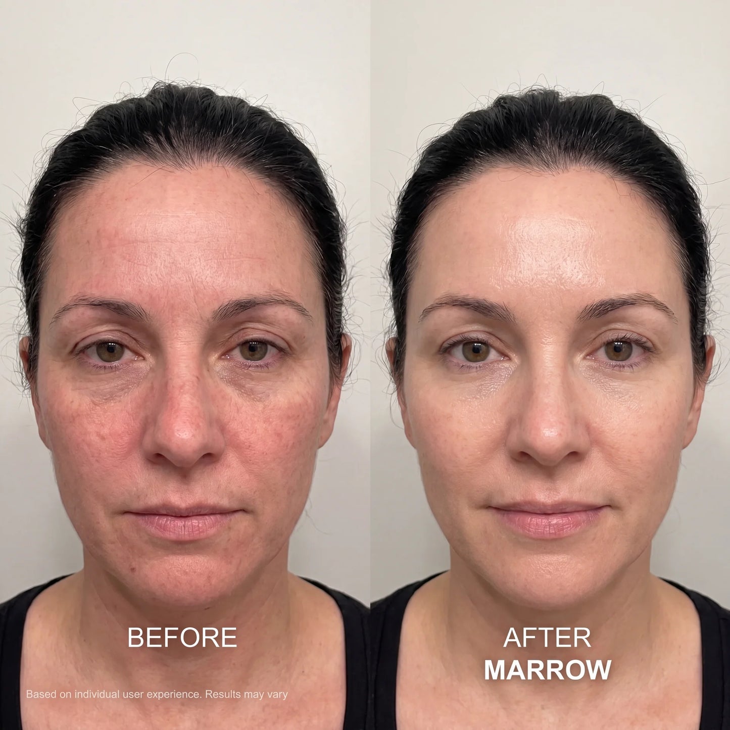 The Marrow System™ — At-Home Microinfusion