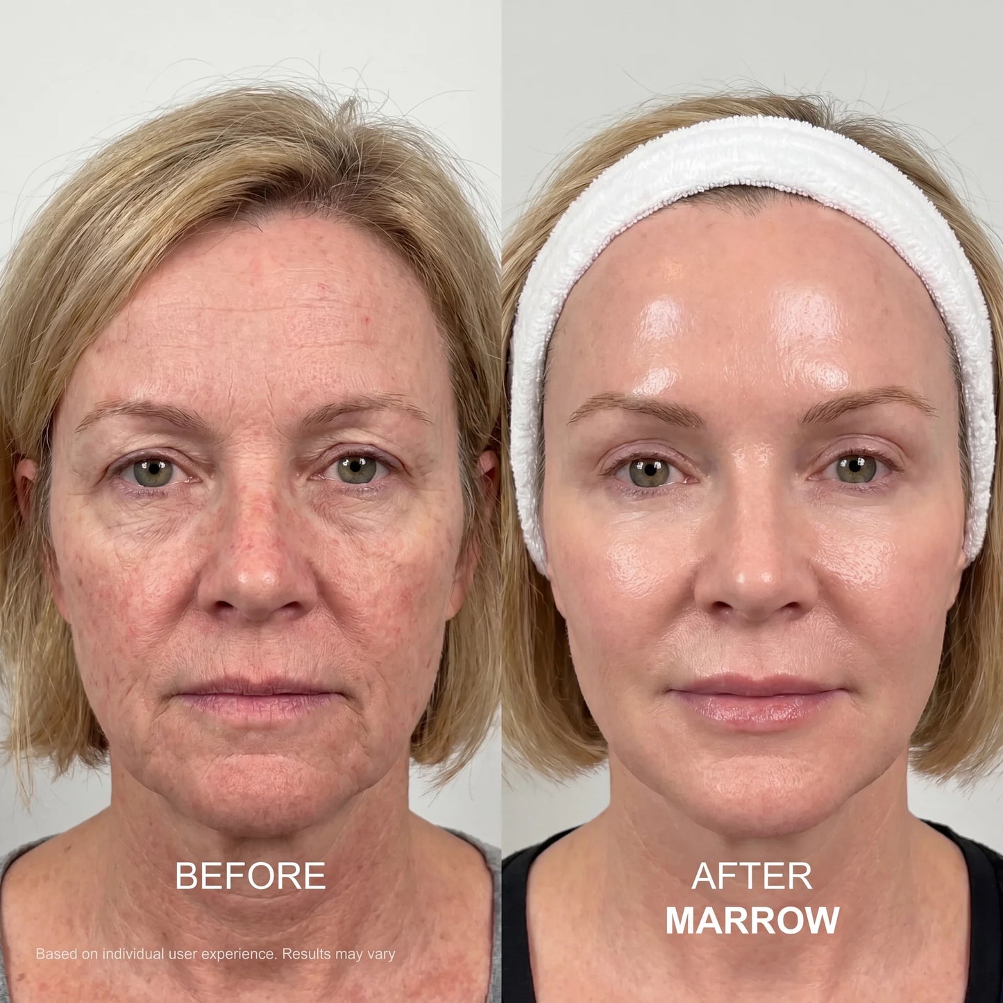 The Marrow System™ — At-Home Microinfusion