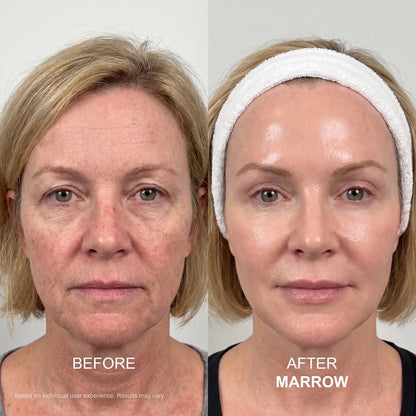 The Marrow System™ — At-Home Microinfusion